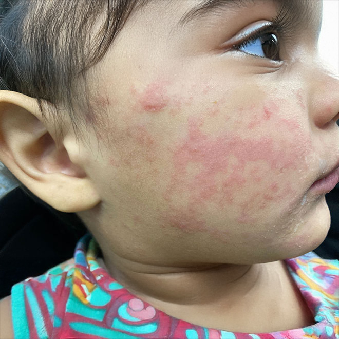 What you need to know about measles